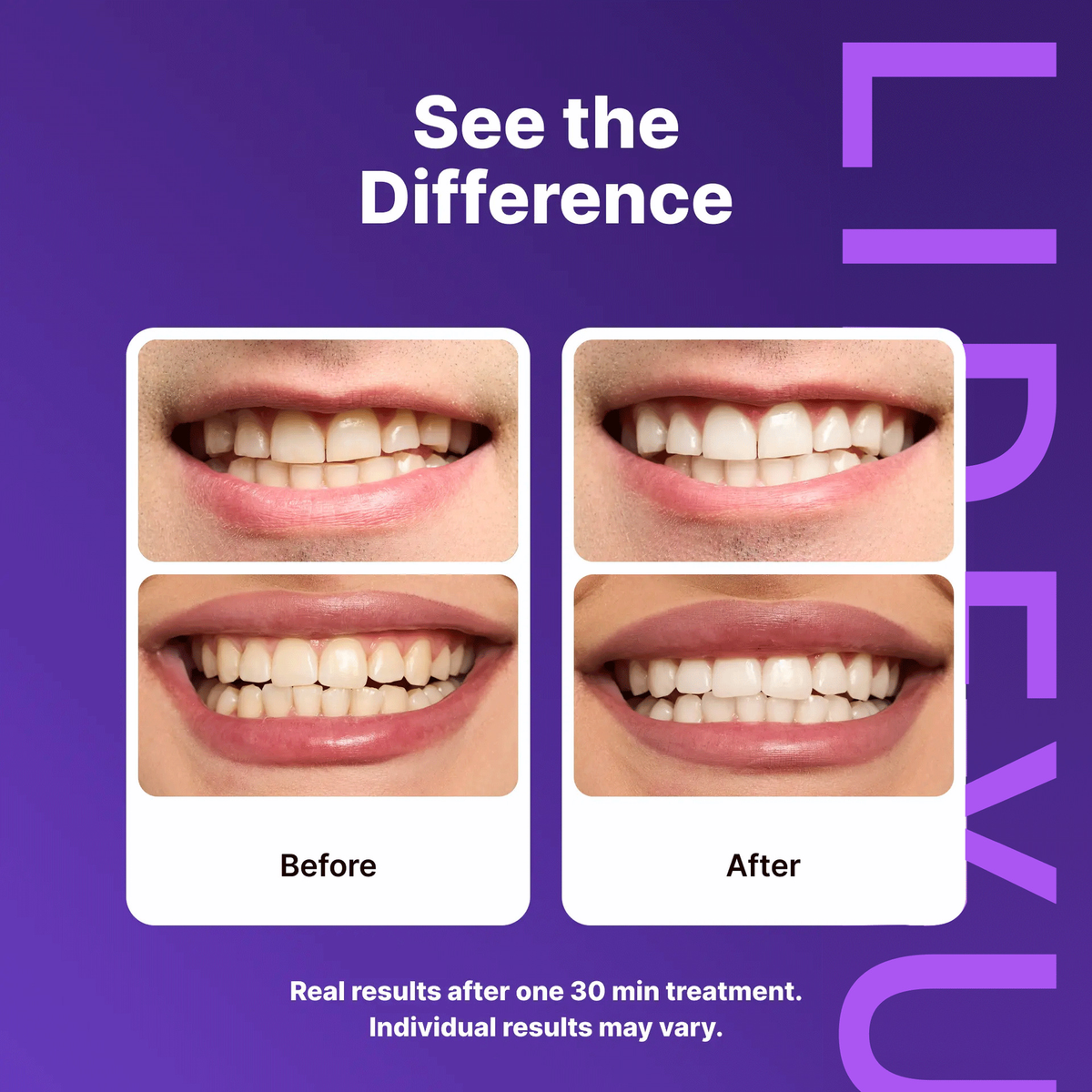 Makelune Dual-Action Whitening Strips — PAP Deep Whitening + Purple Color-Correcting